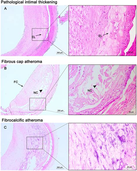 Frontiers | Histological Characteristics of Intracranial Atherosclerosis in a Chinese Population ...