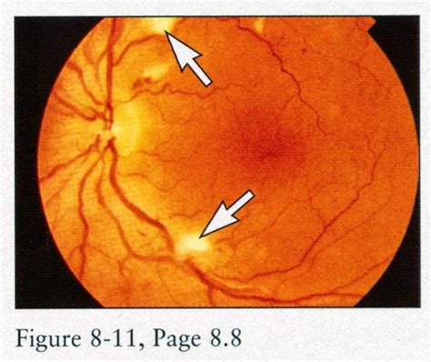 Read It: Retinopati Hipertensi