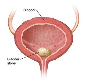 Understanding Bladder Stones
