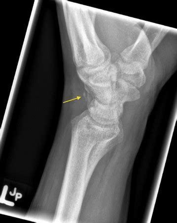 Triquetral fracture - Radiology at St. Vincent's University Hospital