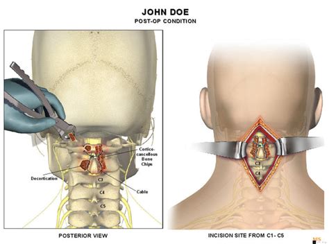 Copy of 1 Level - C1-C2 Posterior cervical fusion — Medical Art Works