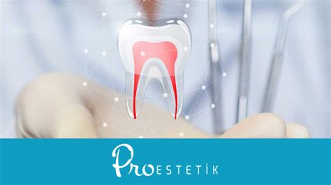 Root Canal Treatment - What Is It? - ProEstetik