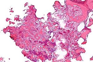 Osteoid osteoma - Libre Pathology