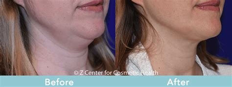 Coolsculpting Double Chin Before & After #6 - Zcosmetic Health