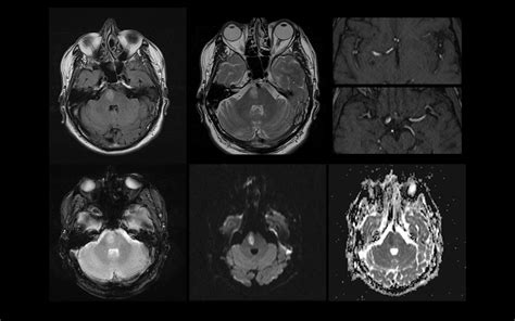 Brain, MRI, MRA - acute right pontine infarct, small right… | Flickr