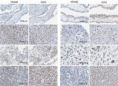 PRAME protein expression in DICER1‐related tumours - Thorner - 2022 ...