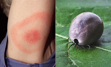 Woman catches Lyme disease from tick bite at Clissold Park, say residents - Hackney Citizen