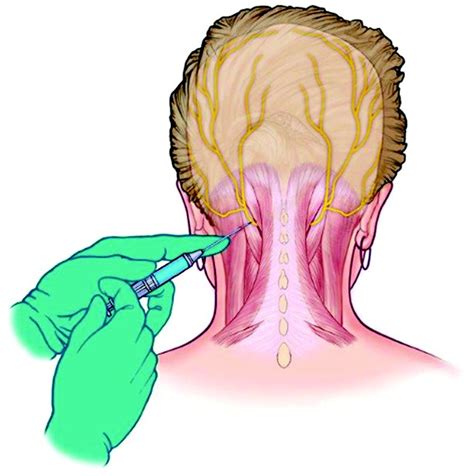 Occipital Nerve Block Anatomy | Images and Photos finder