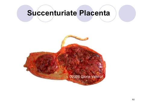 Wiki.placental abnormalities1