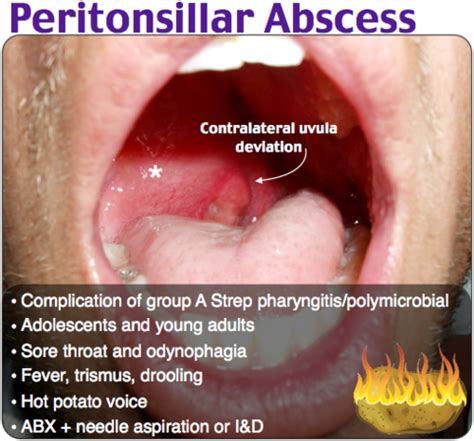 Deviated Uvula Sore Throat