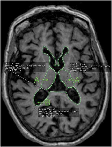 Frontiers | The yearly rate of Relative Thalamic Atrophy (yrRTA): a simple 2D/3D method for ...