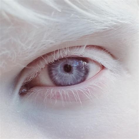 What Color Eyes Do Albino Humans Have - Etheridge Larry