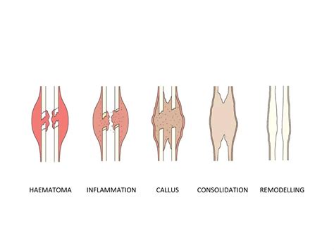 Bone healing | PPT