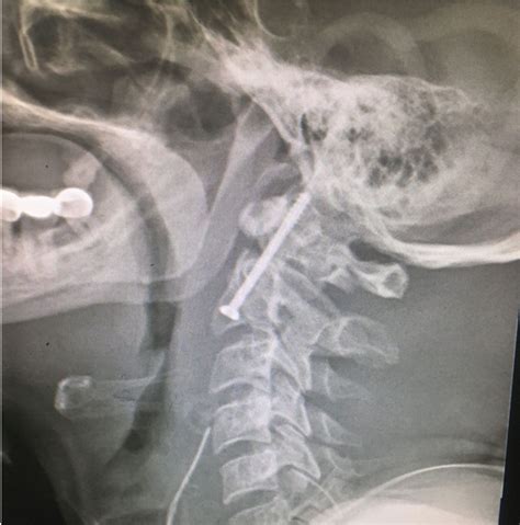 Fractures of C2 (Axis) Vertebra: Clinical Presentation and Management ...