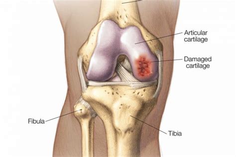 Cartilage Repair Surgery in Bangalore | Cartilage Repair Treatment