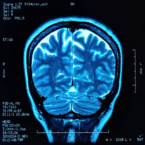 Depression Brain Scan