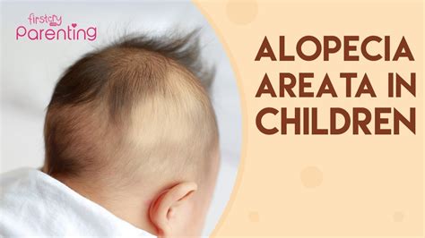 Alopecia Areata in Children - Causes, Signs & Treatment - YouTube