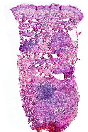 Necrobiosis Lipoidica Diabeticorum Histology