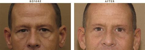 Eyelid lift surgery (blepharoplasty) – Before and After Pictures * – Dr Turowski – Plastic ...