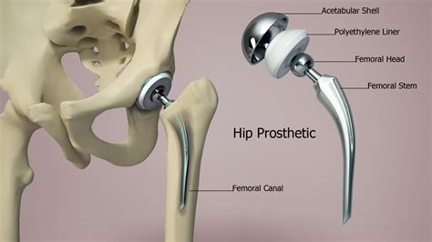 Hip Replacement | Dr. Anuj Singh's Hip & Knee Centre