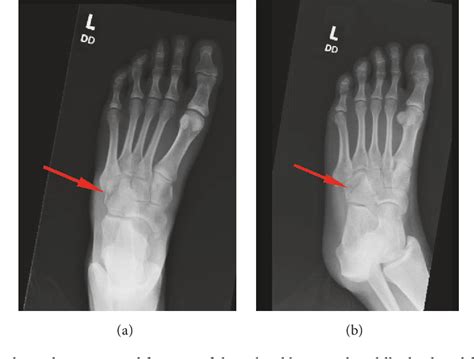 Figure 1 from Nutcracker Cuboid Fracture: A Case Report and Review | Semantic Scholar