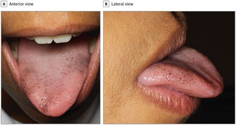 Pigmented Fungiform Papillae of the Tongue | Adolescent Medicine | JAMA Dermatology | JAMA Network