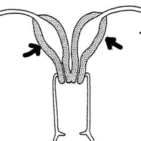 Illustration of uterus didelphys in our clinical case. The arrows are... | Download Scientific ...