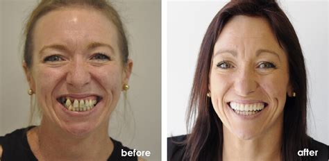Bad Teeth Repair Before And After - TeethWalls