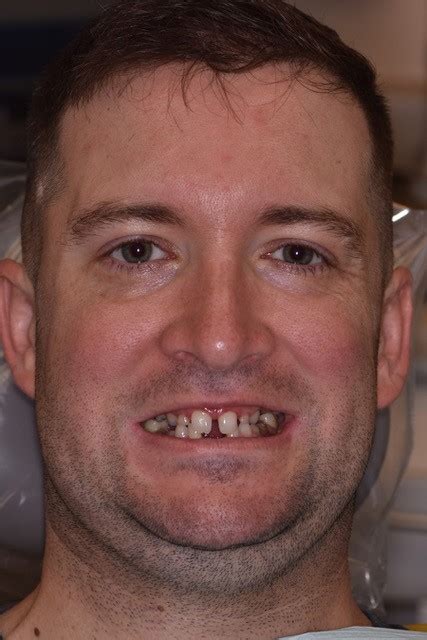 Man with Rare Condition Has 21 Baby Teeth Removed | URMC Newsroom