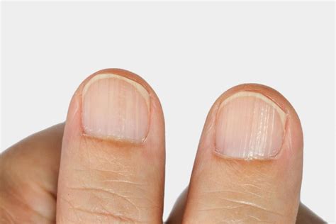 Ridged nails - What are they & What does it mean?