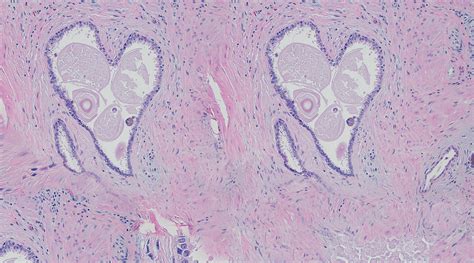 Pathology Of Genitourinary System