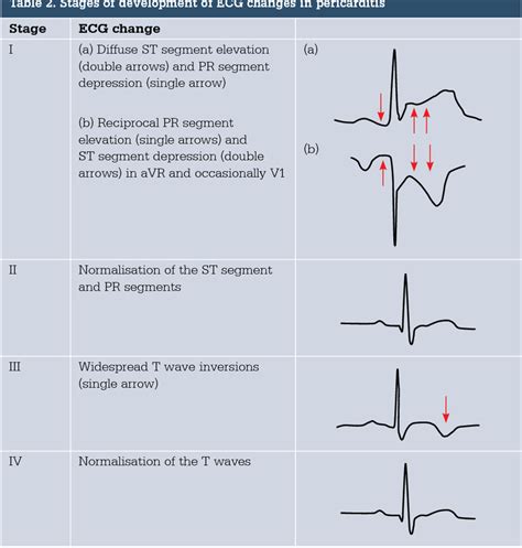 Satges of ECG changes in Pericarditis - MEDizzy