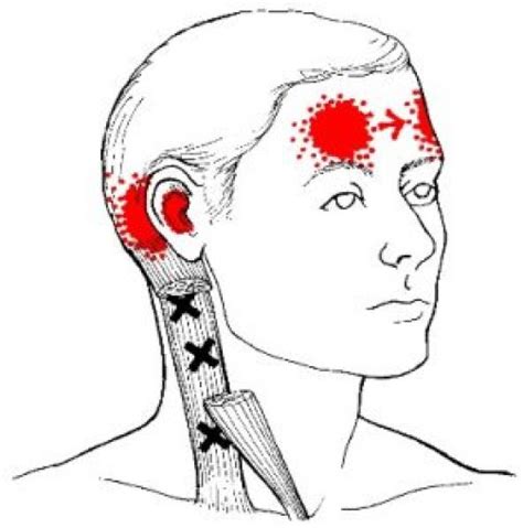 Sternocleidomastoid Trigger Points and Referred Pain Patterns ...