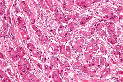 File:Fibrolamellar hepatocellular carcinoma - high mag.jpg - Wikimedia Commons