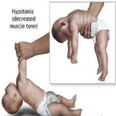 Hypotonia on Pinterest | Muscle, Gross Motor and Michelangelo