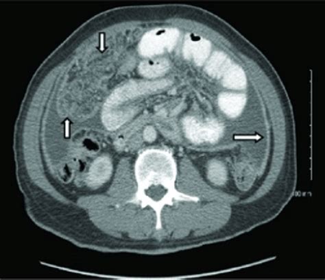 Computed tomography scan of abdomen showing moderate amount of ...