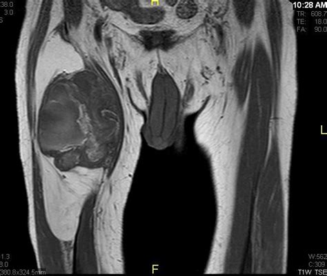 Tumor Surgery > Tumor Education > Soft Tissue Tumors > Soft Tissue Tumor Types ...