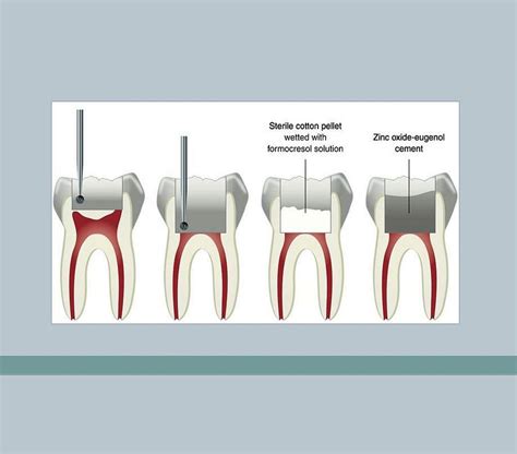 Pulpectomy With MTA Dental Care, 50% OFF