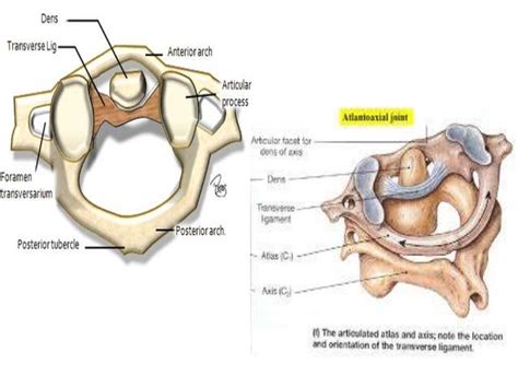 Imaging of atlanto occipital and atlantoaxial traumatic injuries