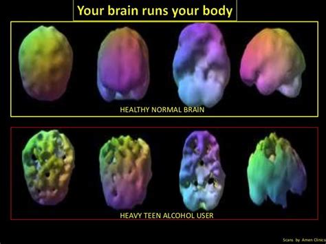 Daniel Amen Brain Scans | Agy Felvételek - Mindenütt, Mindenkinek Segíts, Jó Szóval ... | Fish ...