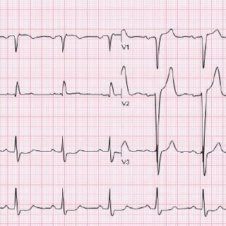 Intraventricular Conduction Delay Ekg