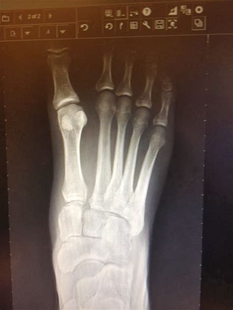 After LisFranc Surgery