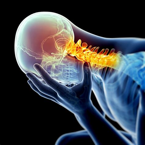 Cervicogenic Headache - Causes and Treatments - Chatfield Family ...