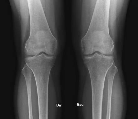 Normal knees x-rays | Radiology Case | Radiopaedia.org