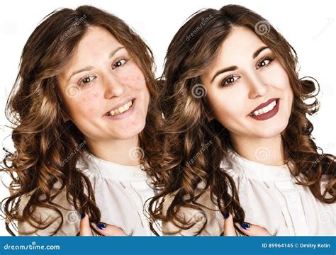 Girl with Acne before and after Treatment Stock Image - Image of face, acne: 89964145