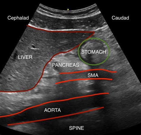 [Figure, Gastric ultrasound anatomy, including liver,...] - StatPearls ...