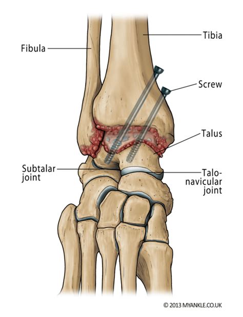 Ankle Fusion — Ankle Arthritis | Ankle Replacement | Arthrodesis ...