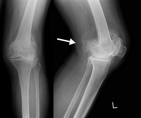 Popliteal artery entrapment by an enlarged sesamoid bone - Journal of Vascular Surgery Cases ...