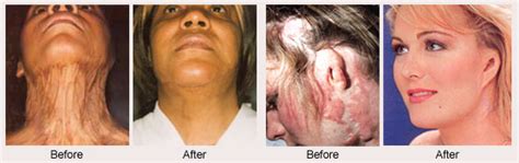 Burn Reconstructive Surgery - Upper East Side New York, NY: Elliott H ...