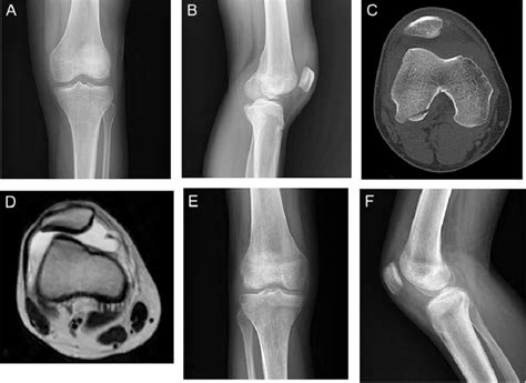 Case 2. A and B Radiography showing lateral femoral condyle OCF and... | Download Scientific Diagram